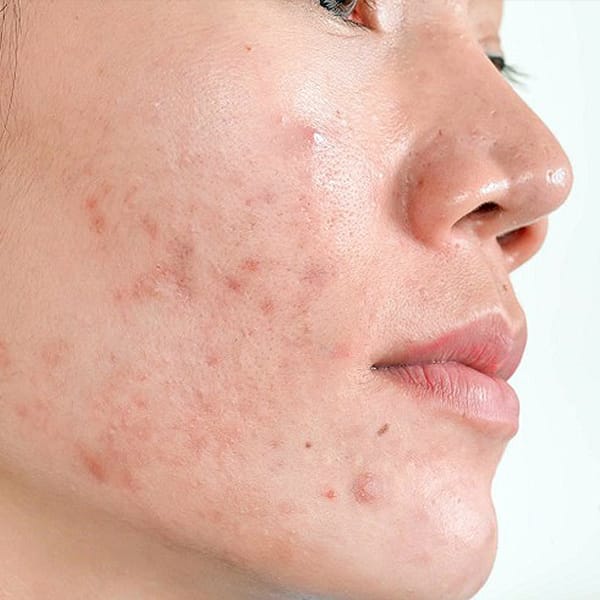 PICO Pores & Scars Laser Amaris B. Clinic by Dr. Ivan Puah